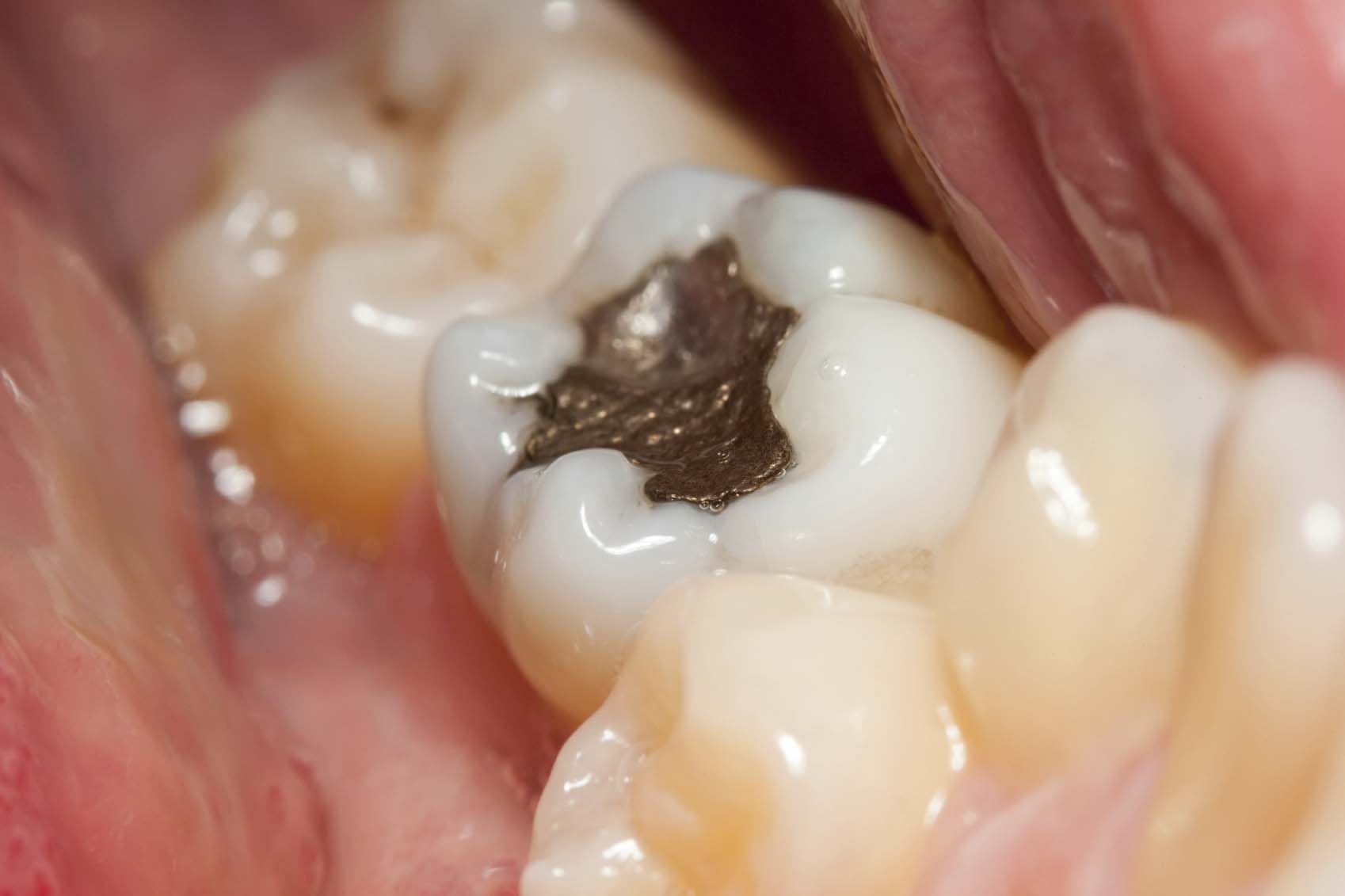 اتفاقية ميناماتا الدولية وملاغم الأسنان 2 Macro of a tooth with amalgam filling