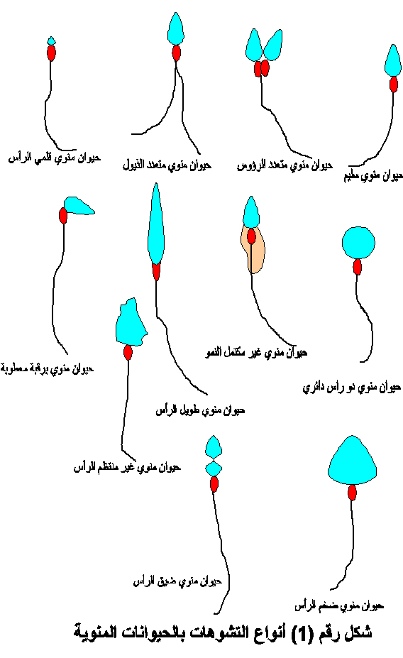 حيوان منوي مشوه