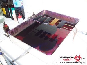 مراكز علاج السل: التحدي الكبير في إدارة المخلفات الطبية