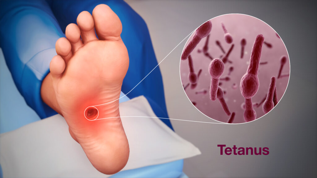 أهمية التطعيم ضد الكزاز (Tetanus) في منع العدوى من حالات وخز الإبر والحقن في العاملين مع النفايات الرعاية الصحية 2 أهمية التطعيم ضد الكزاز (Tetanus) في منع العدوى من حالات وخز الإبر والحقن في العاملين مع النفايات الرعاية الصحية