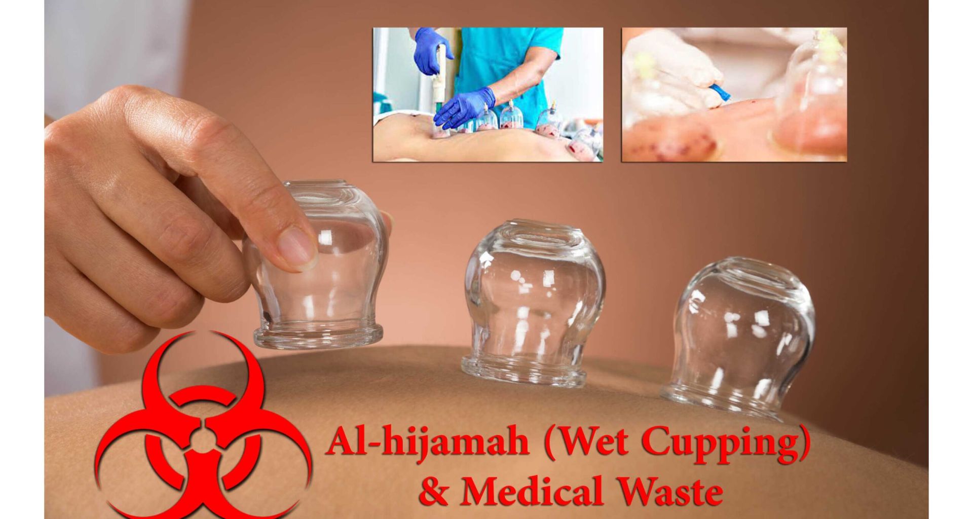 الحجامة الرطبة و مصير نفاياتها الطبية 1 الحجامة الرطبة و مصير نفاياتها الطبية
