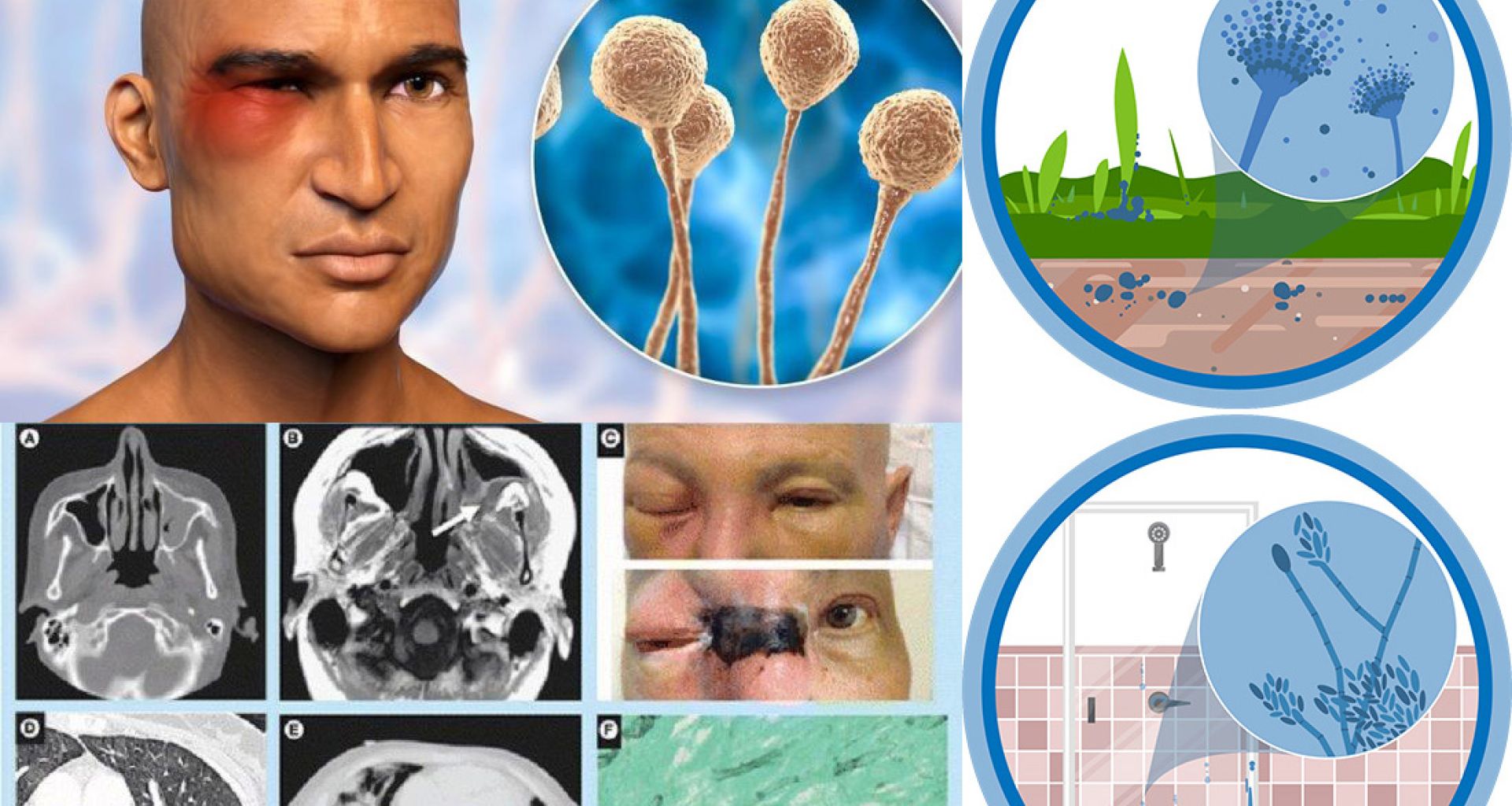 الفطر الأسود: أنواعه، انتشاره، تشخيصه، علاجه، الوقاية منه. 1 الفطر الأسود: أنواعه، انتشاره، تشخيصه، علاجه، الوقاية منه.