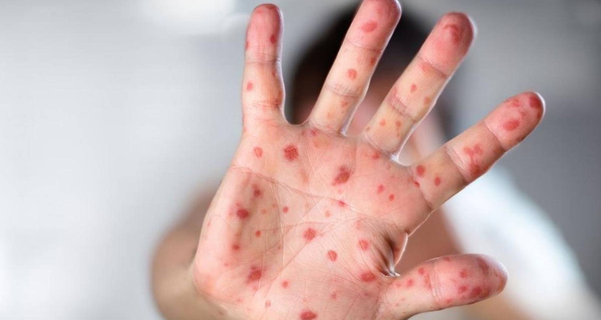 مرض فيروس جدري القرود وإدارة النفايات الطبية 1 مرض فيروس جدري القرود وإدارة النفايات الطبية