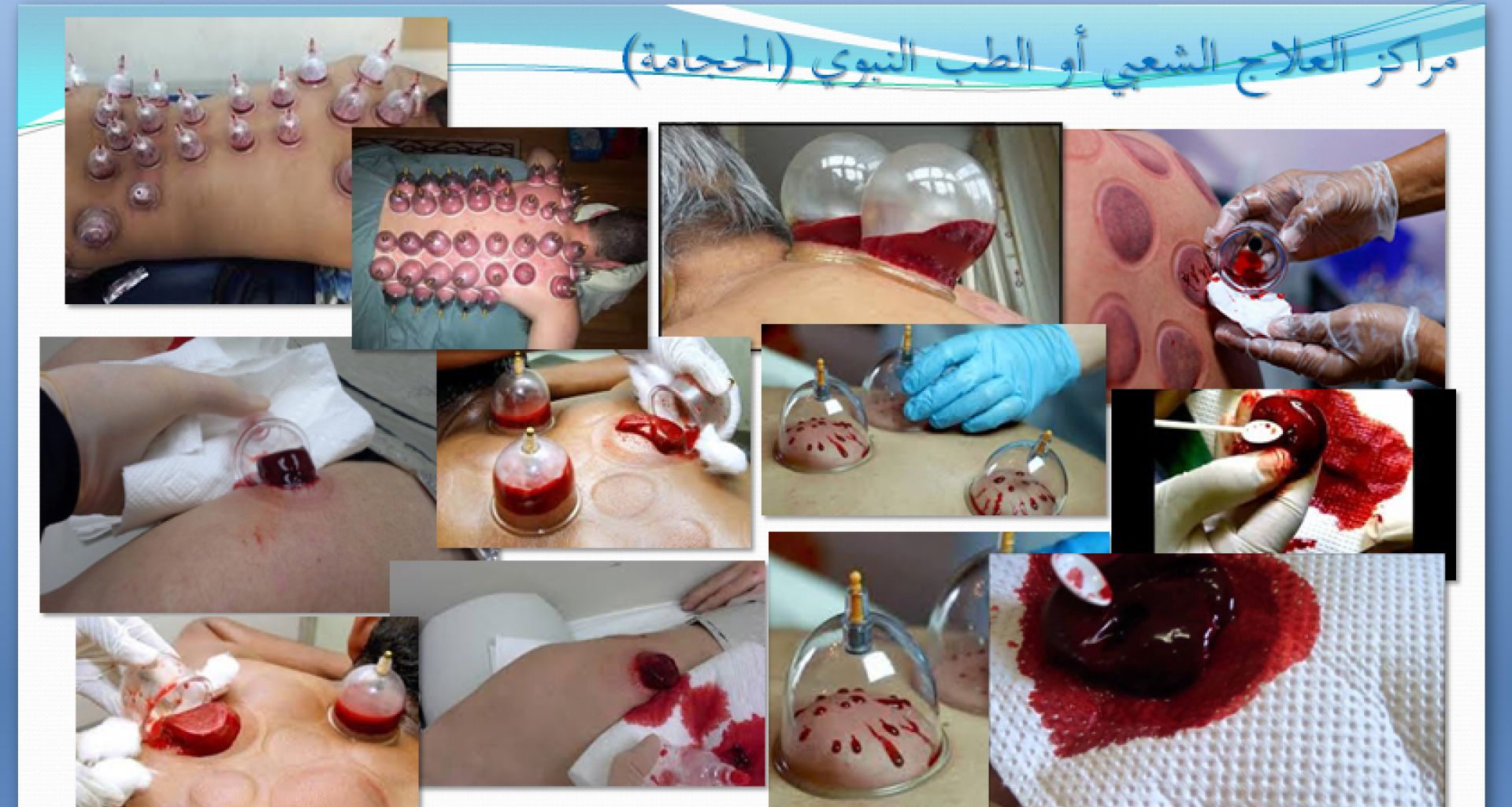 مراكز الحجامة: هل هي مصدر رئيسي لإنتاج النفايات الطبية؟ أم مصدر ثانوي؟ 1 مراكز الحجامة: هل هي مصدر رئيسي لإنتاج النفايات الطبية؟ أم مصدر ثانوي؟