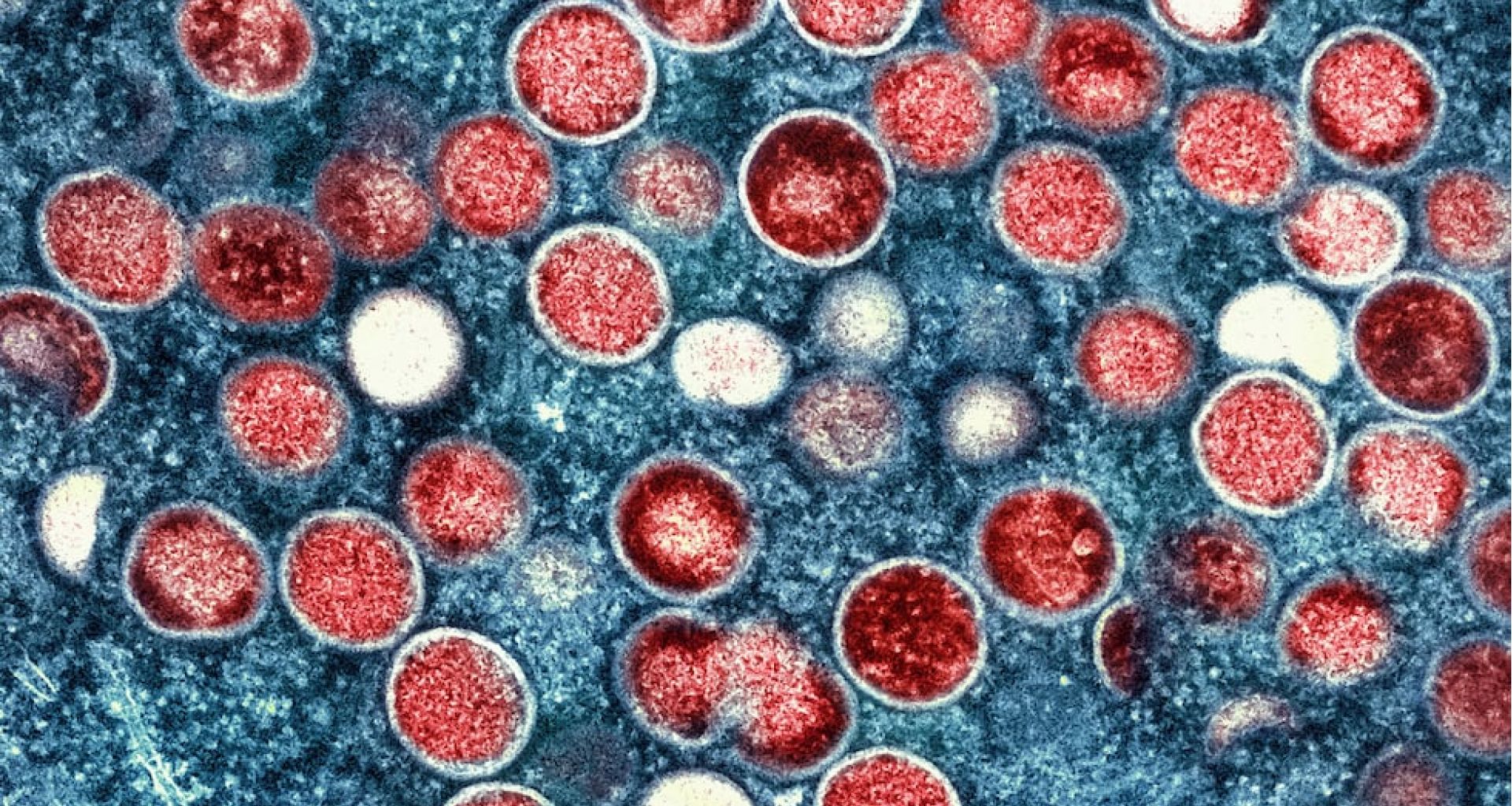 طرق انتقال عدوى فيروس جدري القرود 1 طرق انتقال عدوى فيروس جدري القرود