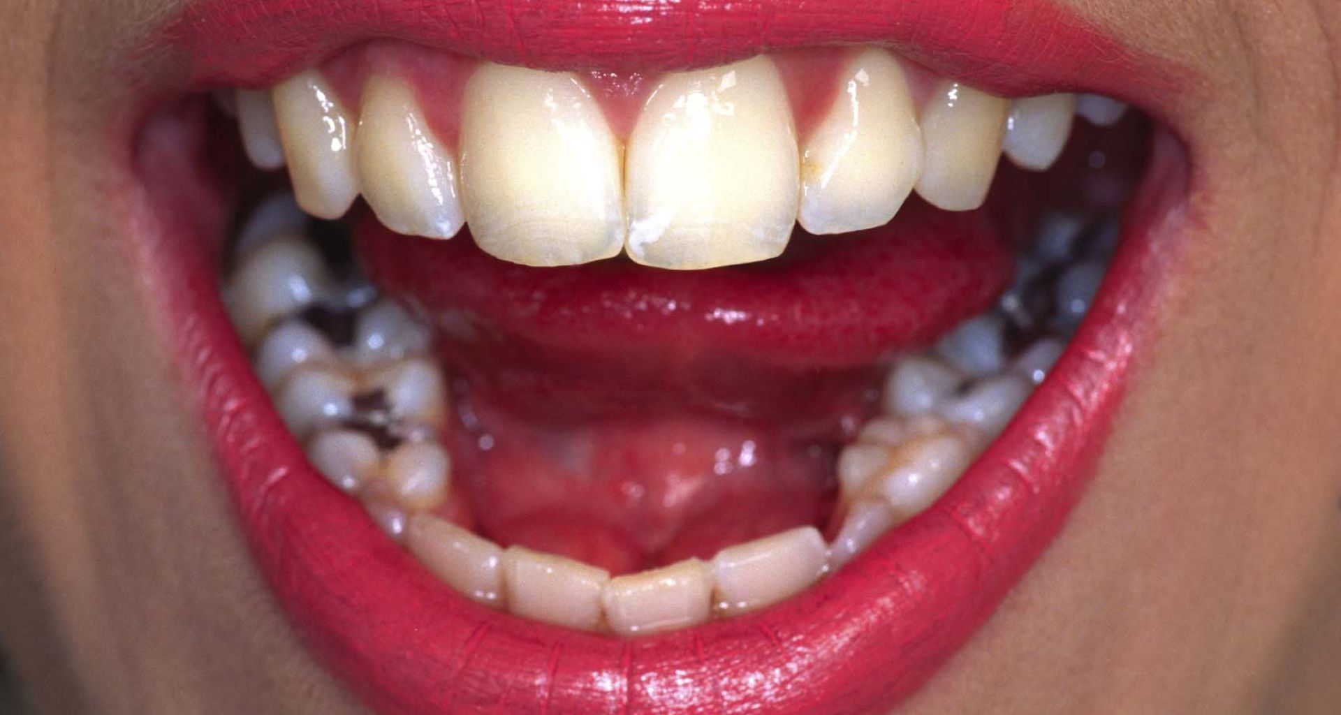 اتفاقية ميناماتا الدولية وملاغم الأسنان 1 اتفاقية ميناماتا الدولية وملاغم الأسنان