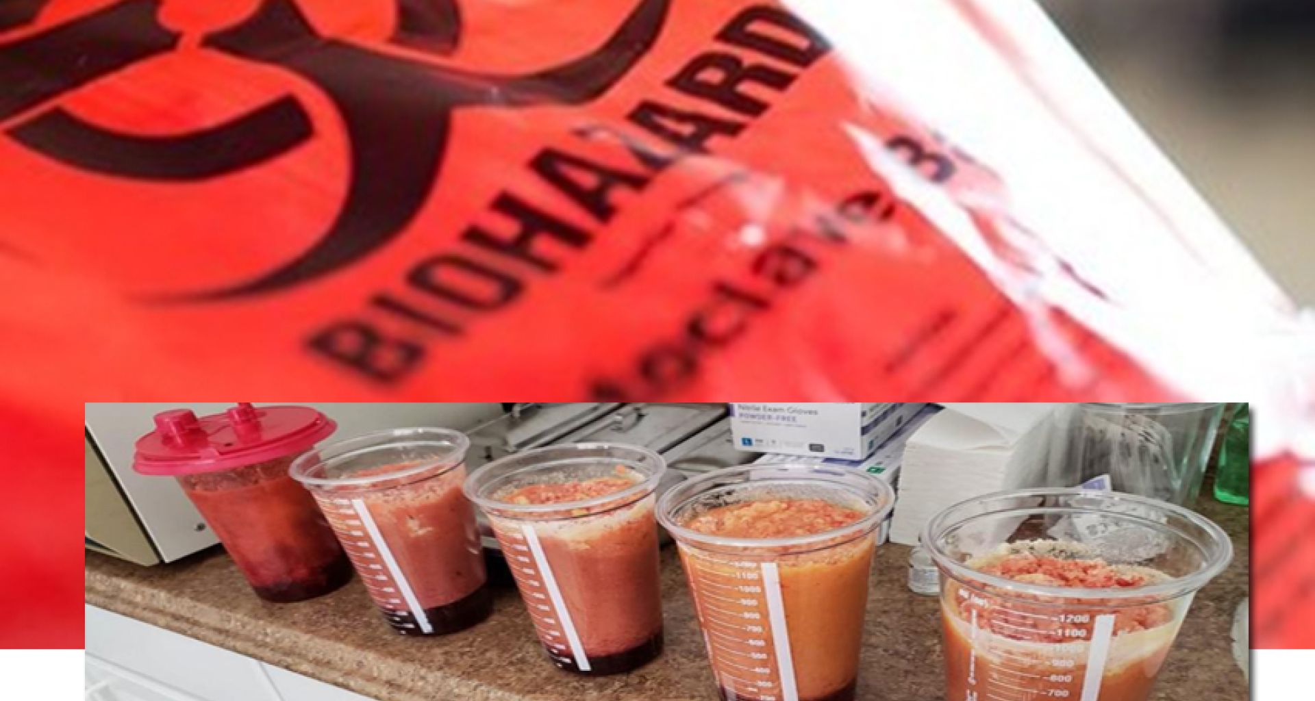 النفايات الباثولوجية: كيف يتم التخلص من الدهون بعد عملية شفط الدهون؟ 1 النفايات الباثولوجية: كيف يتم التخلص من الدهون بعد عملية شفط الدهون؟