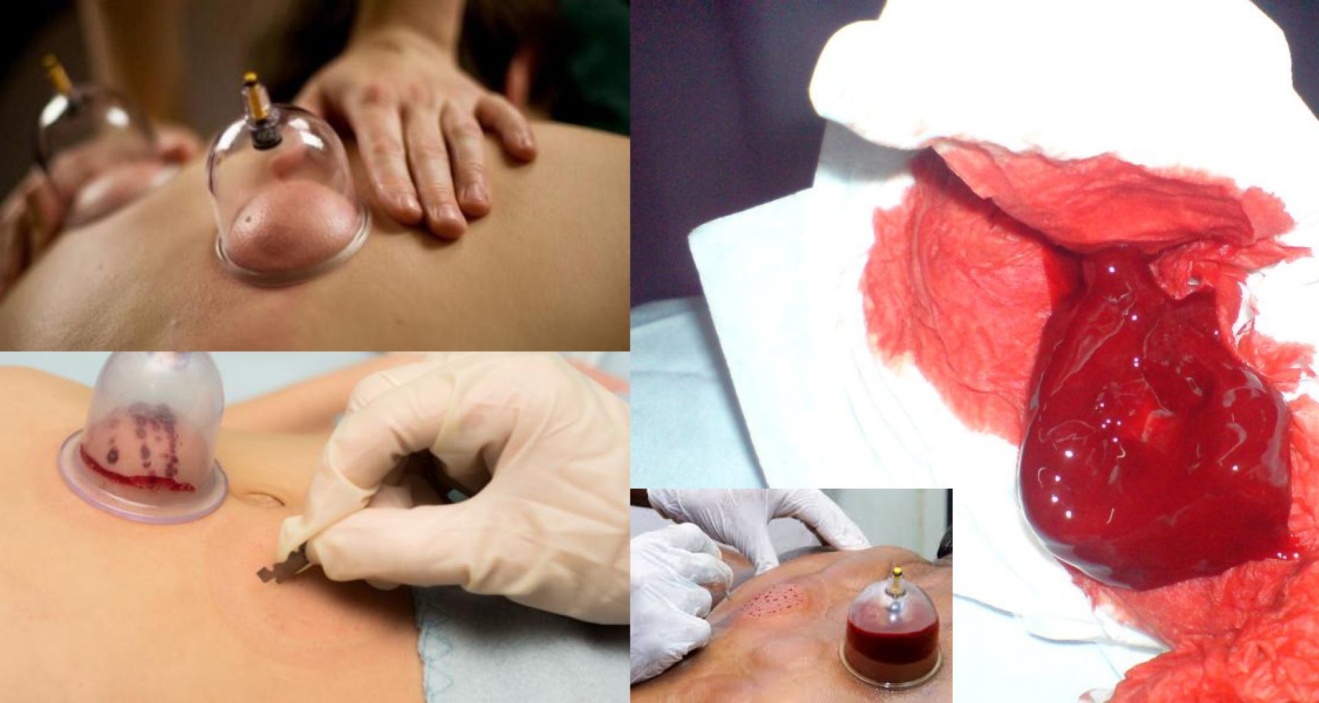 التخلص من النفايات الطبية في مراكز الحجامة أنها ليست مشكلة بيئية؟