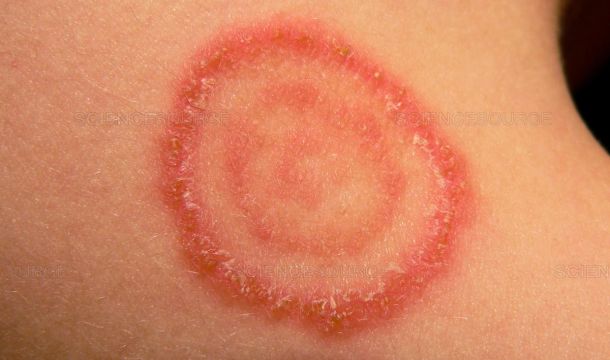 الإصابات الجلدية بفطر (Dermatophytes) نتيجة ملامسة النفايات الرعاية الصحية