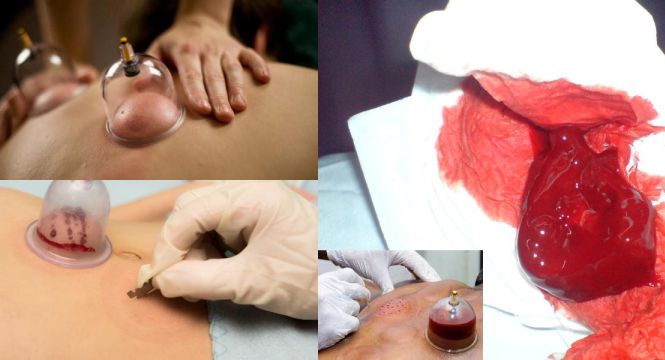 التخلص من النفايات الطبية في مراكز الحجامة أنها ليست مشكلة بيئية؟
