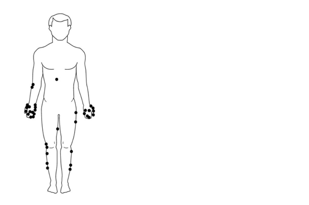 إصابات وخز الإبر (Needle stick Injury)