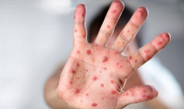 الرئيسية 26 مرض فيروس جدري القرود وإدارة النفايات الطبية