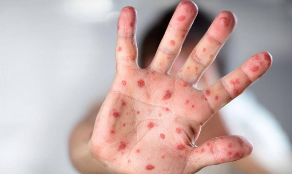 مرض فيروس جدري القرود وإدارة النفايات الطبية