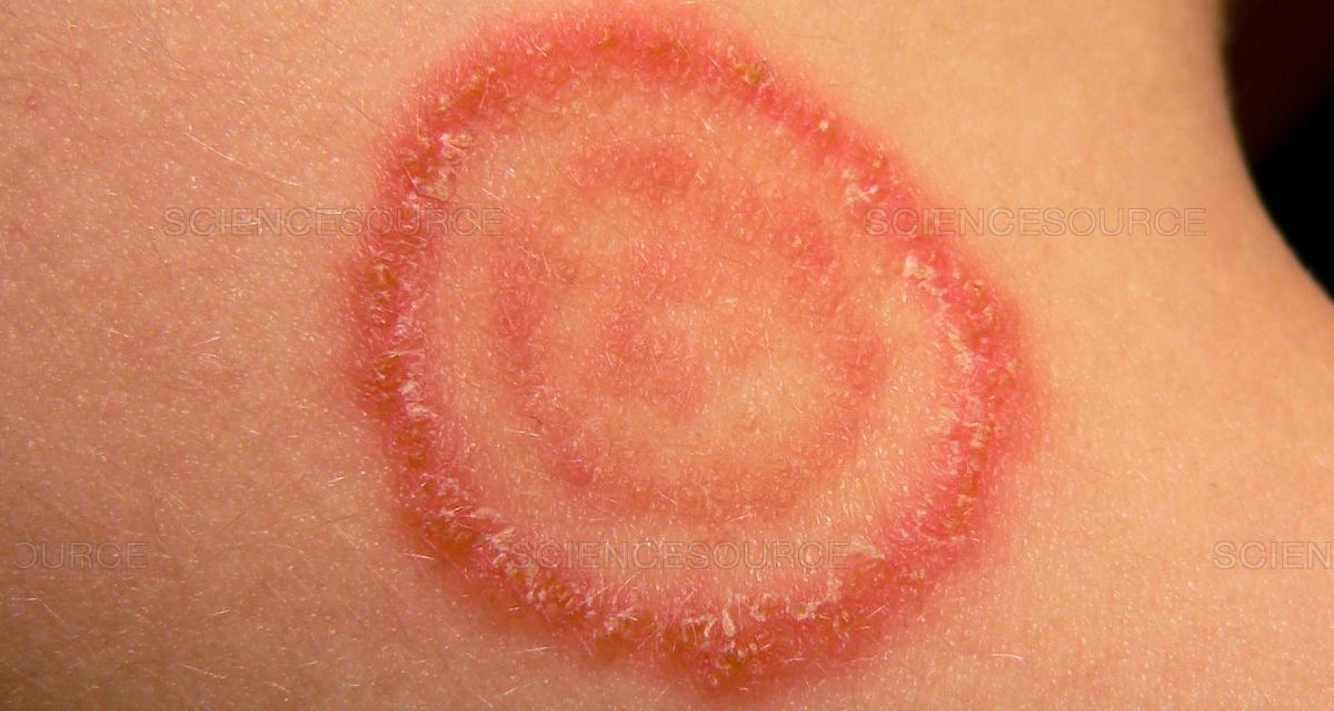 الإصابات الجلدية بفطر (Dermatophytes) نتيجة ملامسة النفايات الرعاية الصحية