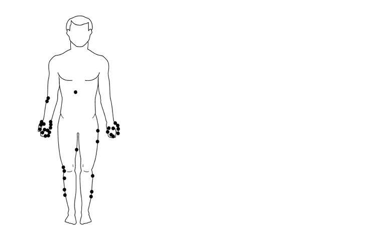 إصابات وخز الإبر (Needle stick Injury)