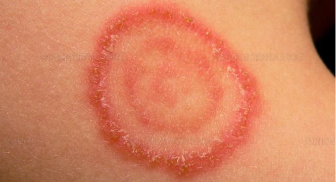 الإصابات الجلدية بفطر (Dermatophytes) نتيجة ملامسة النفايات الرعاية الصحية