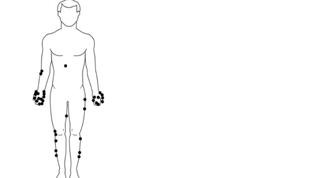 إصابات وخز الإبر (Needle stick Injury)