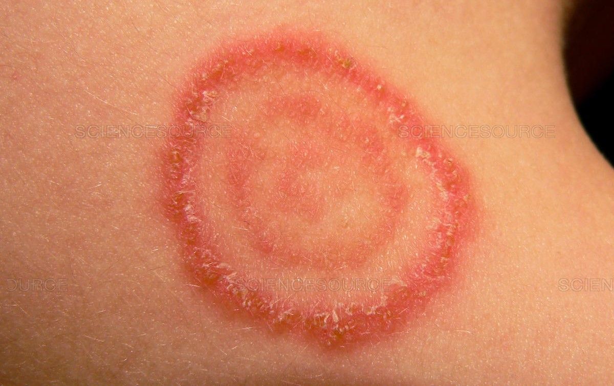 الإصابات الجلدية بفطر (Dermatophytes) نتيجة ملامسة النفايات الرعاية الصحية